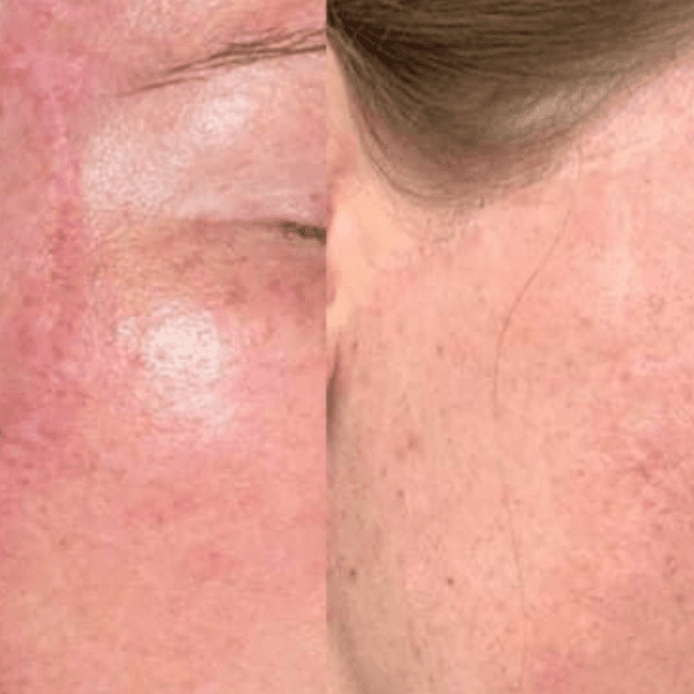 SCAR REVISION PACKAGE [MED SCARS] at GloVolution LLC in Homosassa, FL
