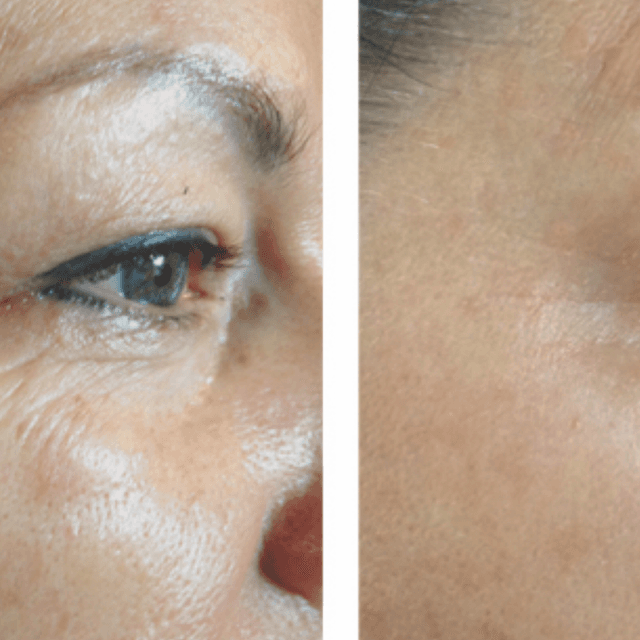 SCAR REVISION PKG [SMALL SCARS] at GloVolution LLC in Homosassa, FL