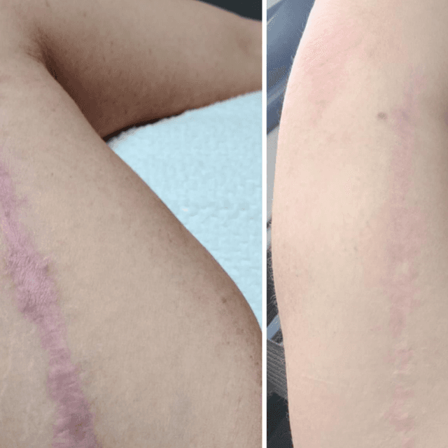 SCAR REVISION PACKAGE [LARGE SCARS] at GloVolution LLC in Homosassa, FL
