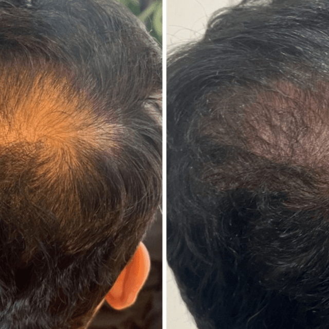 HAIR RESTORATION 6 SERIES at GloVolution LLC in Homosassa, FL